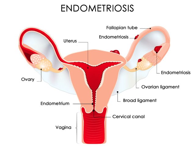 Endometriosis anatomy