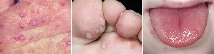 Hand, foot and mouth disease sores
