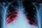 Tuberculosis (TB)