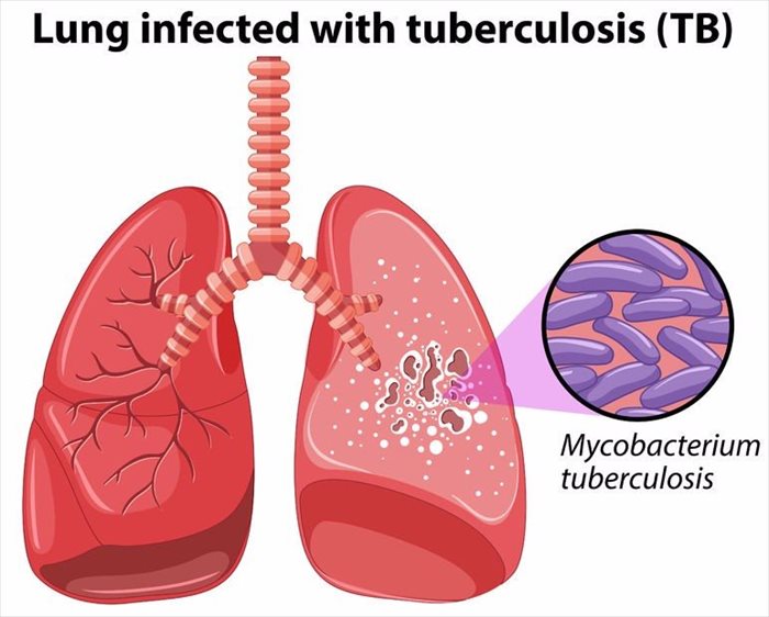 Illustration of a lung infected with tuberculosis (TB)