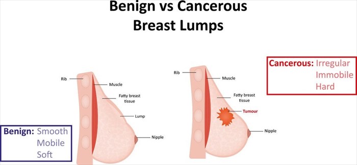 Illustration showing the difference between a benign (non-cancerous) and malignant (cancerous) abnormality in the breast.