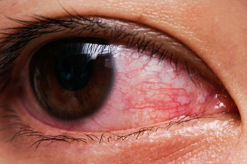 Conjunctivitis (Pink Eye)