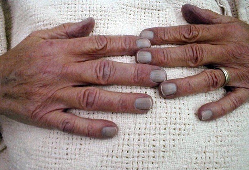 Blue fingernails - The symptom unpacked