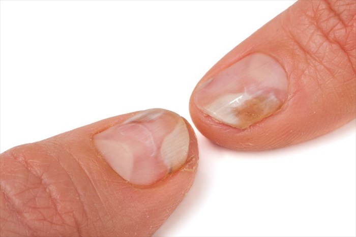 Close-up of a lifted nail plate (fingernails)