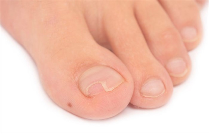 Close-up of a split or broken toenail.