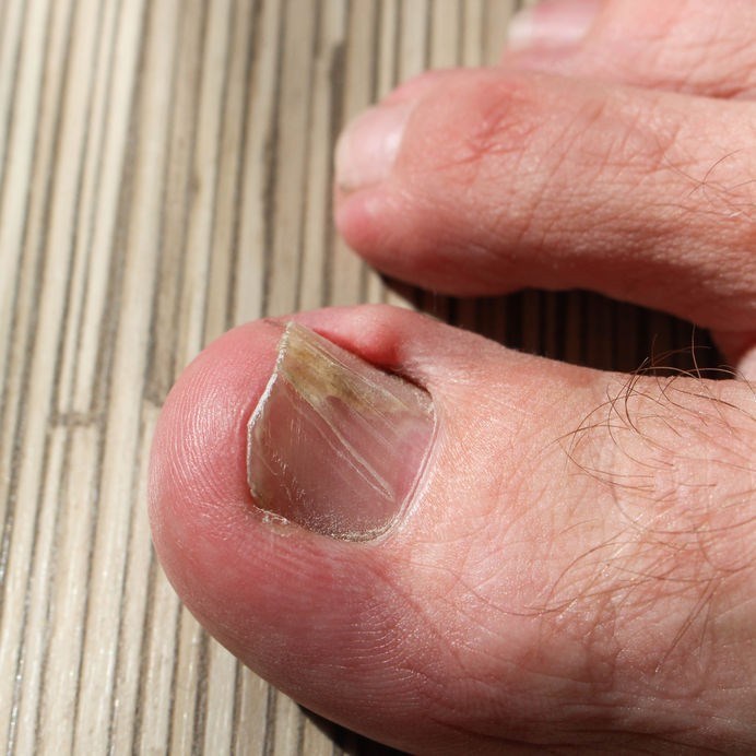Close-up of nail deformation affecting the toenail.