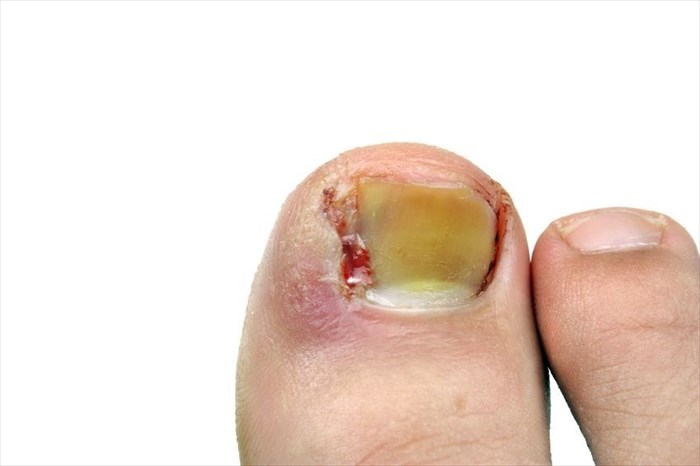 Close-up of an ingrown toenail.