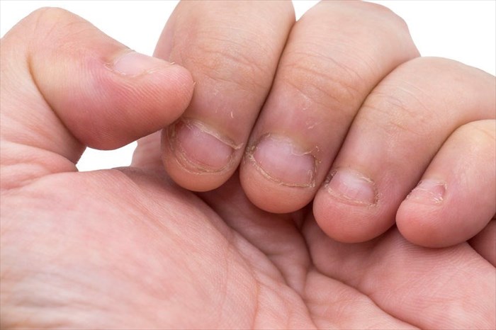 Close-up of bitten fingernails.