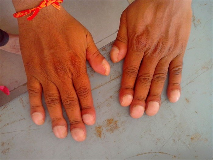 Close-up of fingers / fingernails affected by clubbing.