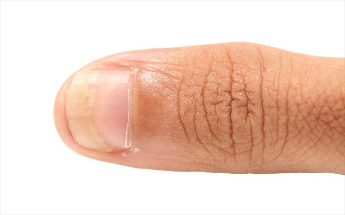 Close-up of thumbnail without a normal lunula.