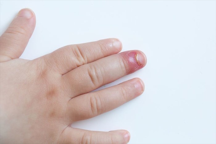 Close-up of young child's hand and fingernail affected by Paronychia.