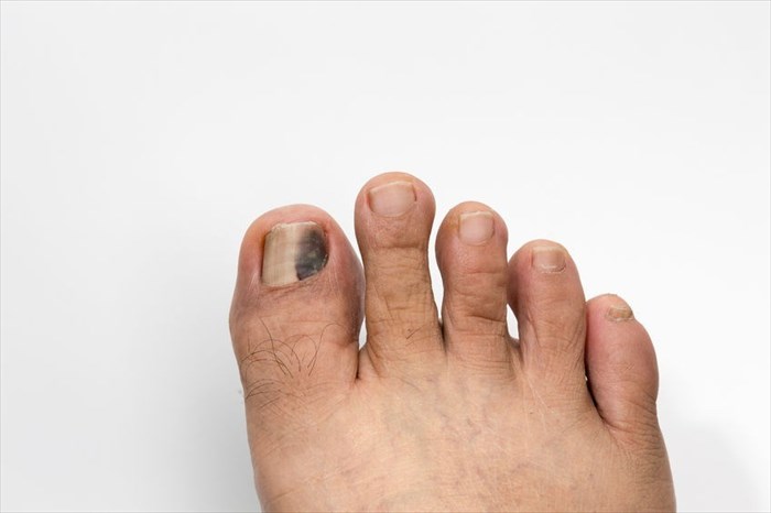 Close-up of toenail affected by a dark streak / stripe (discolouration)