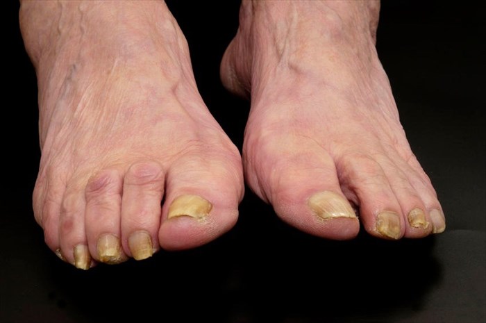 Close-up of toenails affected by Subungual hyperkeratosis