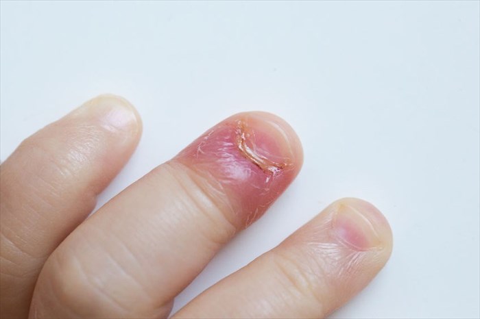Close-up of young child's finger affected by acute paronychia (bacterial infection) 