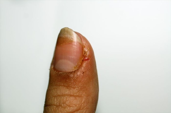 Close-up of fingernail with felon (bacterial infection)