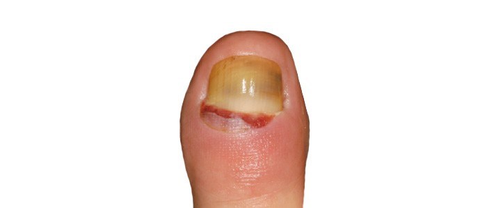 Nail embedding backwards - Retronychia