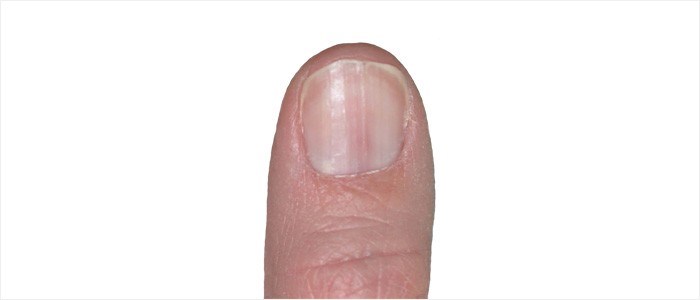Red band or streak on nail - Longitudinal erythronychia