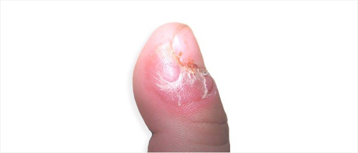 Blistering on fingers and toes - Blistering distal dactylitis