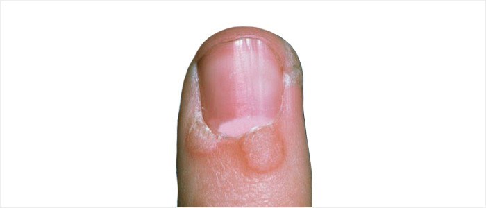 Other Nail Conditions