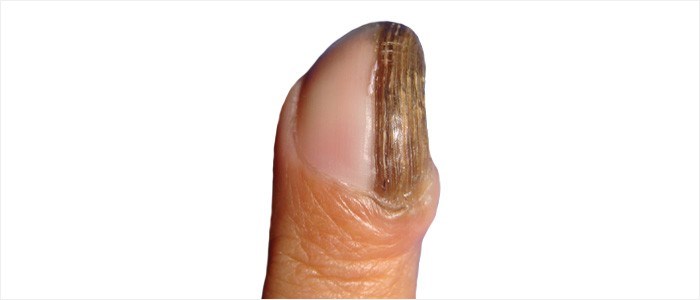 Brown nail - Nail tumour