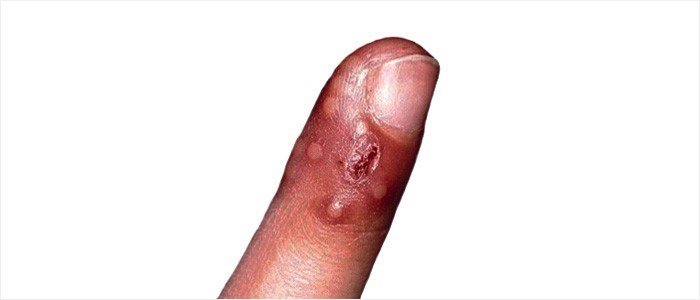 Blisters and sores on fingers - Herpetic whitlow