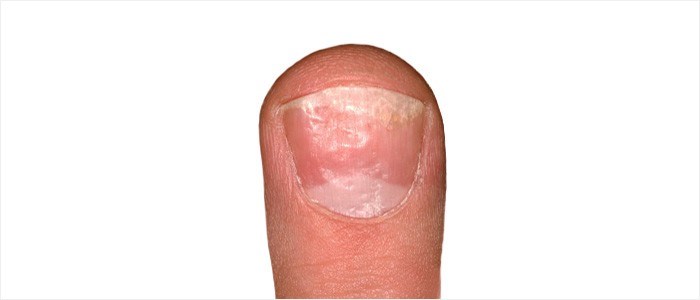 Nail Pitting - dents in nails