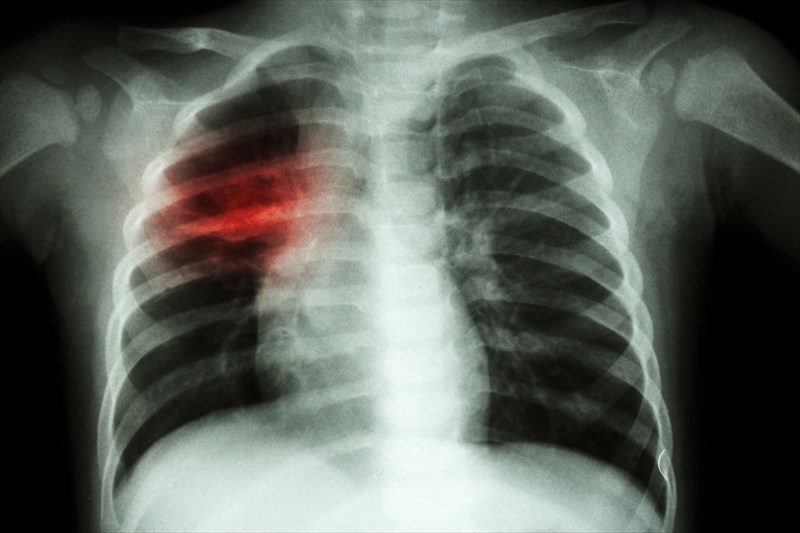 TB - preventable and curable but still infecting millions