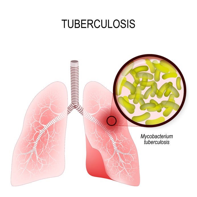 Illustration showing human lungs affected by tuberculosis (TB)