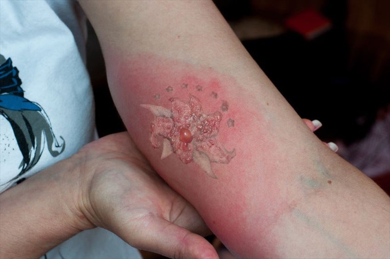 Infected tattoo healing process