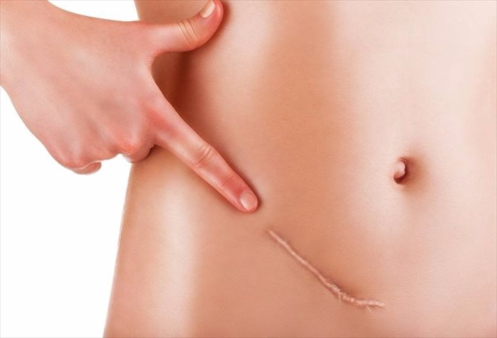 Closeup of woman showing an appendectomy scar