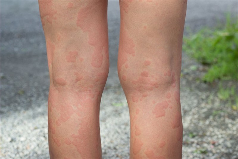What are the signs symptoms of hives?
