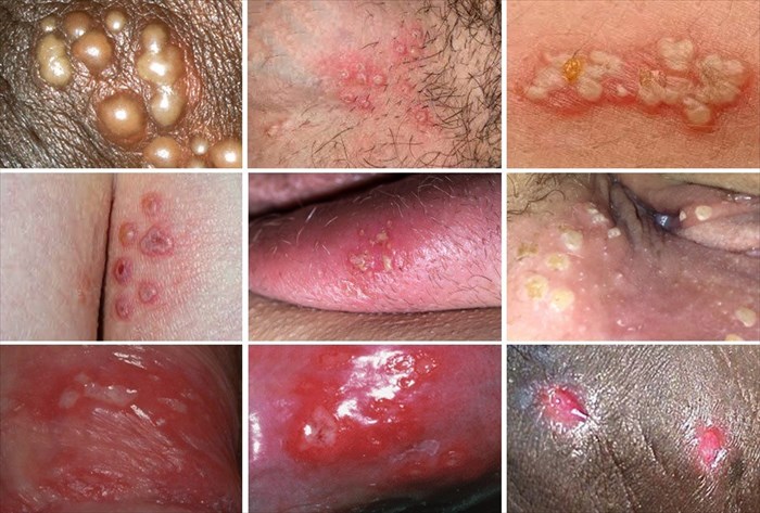 Genital herpes symptoms