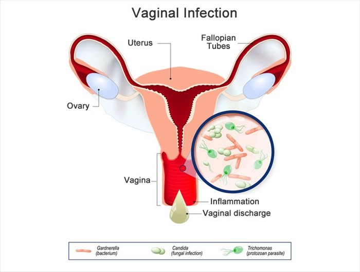 What causes vaginal green-yellow discharge- Vagibiom