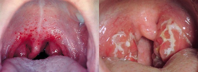 streptococcus throat