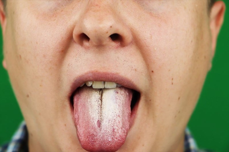 Yeast Infection On Tongue