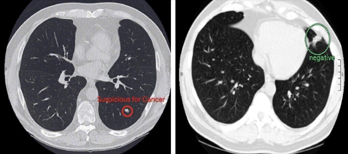 Google AI scans of the lungs