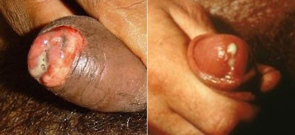 Symptoms of gonorrhea in men - pus-like discharge from the penis