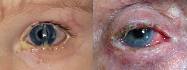 What does pink eye look like