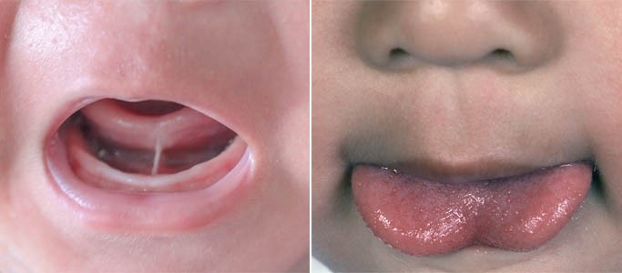 Tongue-tie (ankyloglossia)