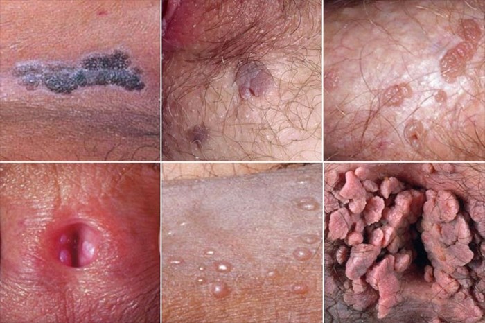 What are the symptoms of HPV as an STI?