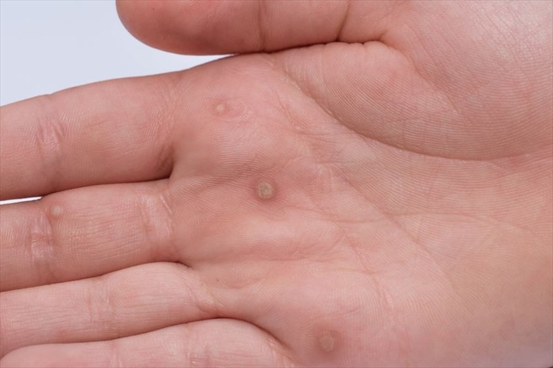which hpv virus causes common warts