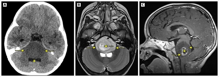 Neuroimaging of Diffuse Intrinsic Pontine Glioma