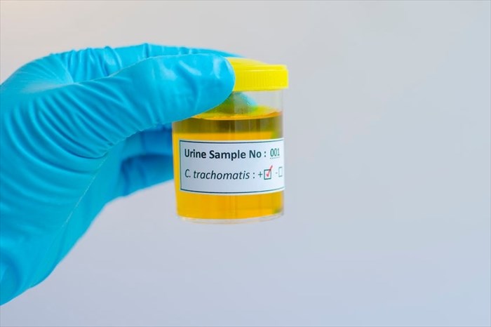 Chlamydia urine sample
