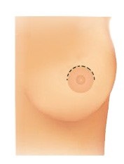 Crescent breast lift