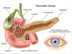 Illustration of pancreatic cancer and signs of jaundice