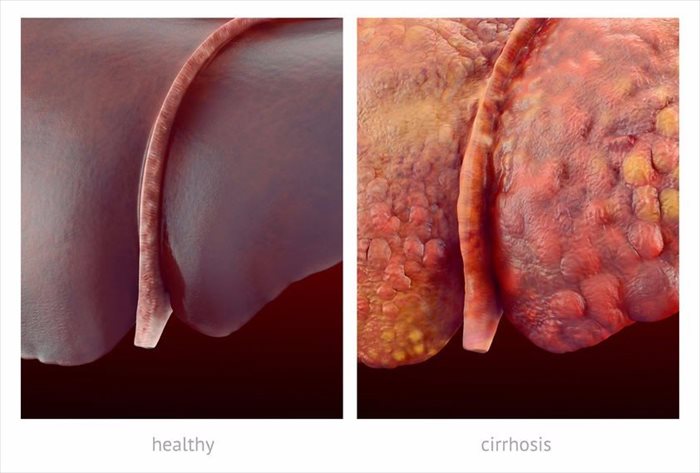 Realistic illustration comparsion of healthy and sick (cirrhosis) human livers