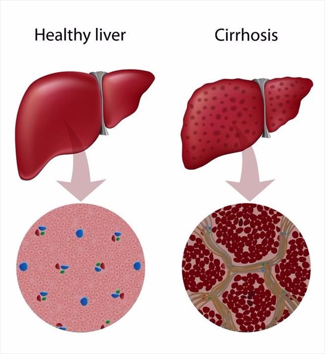 Risk factors and complications associated with hepatitis