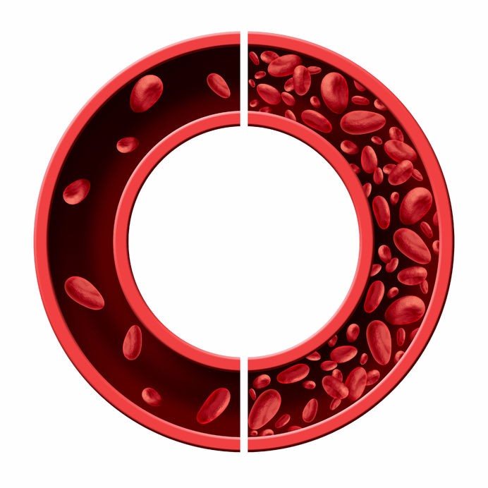 Anaemia medical diagram showing normal and abnormal blood cell count and human circulation in an artery or vein