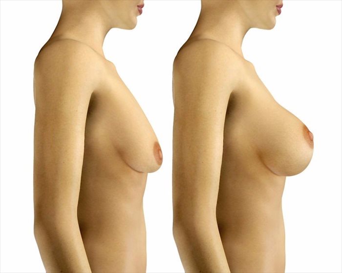 Breast lift with augmentation