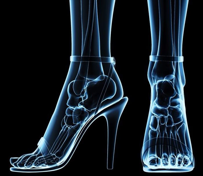 X-ray of feet in heels